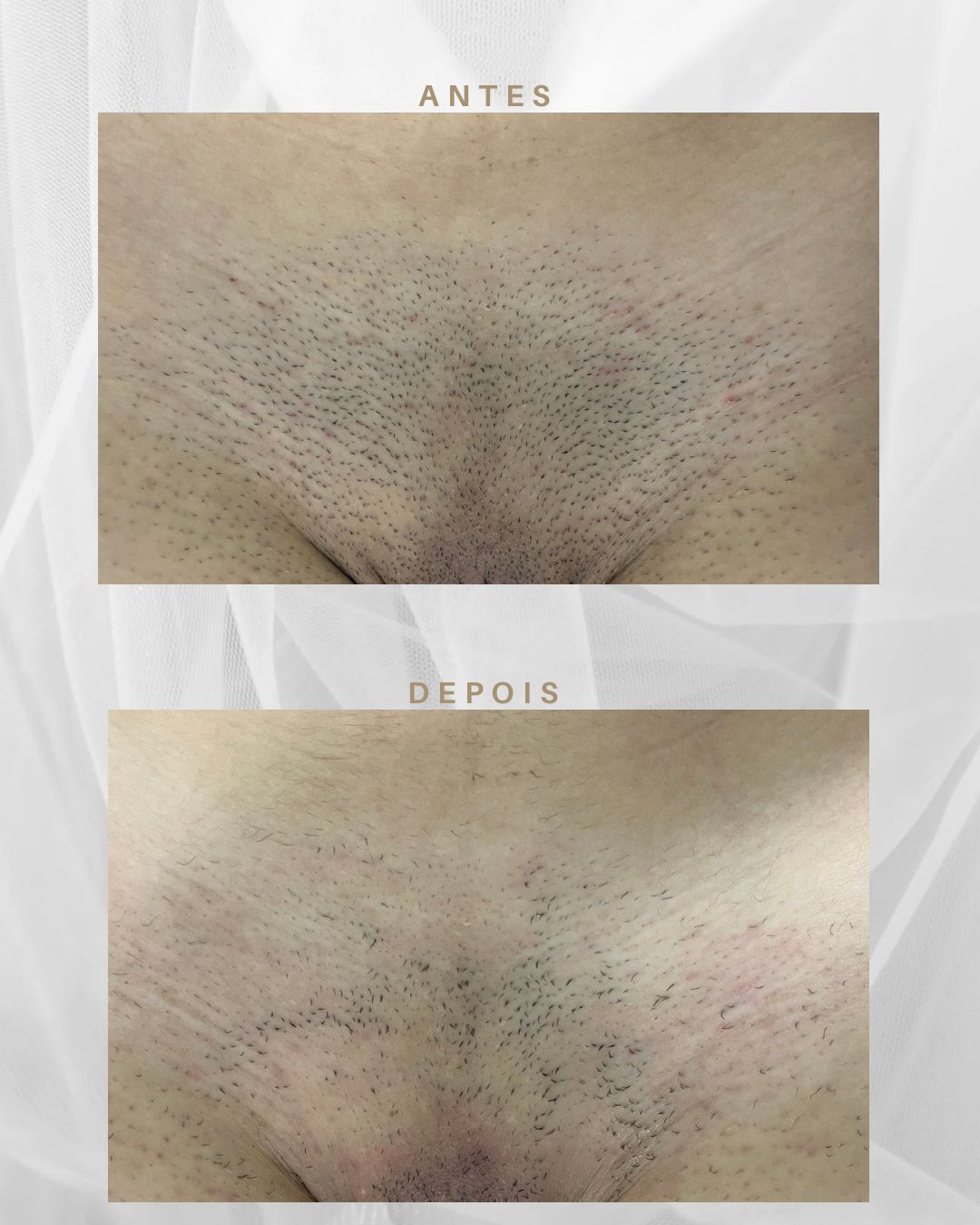Fotodepilação Premium - Antes
